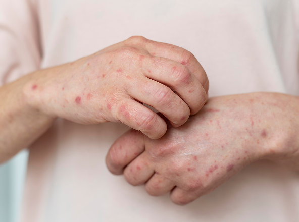 Корь у взрослых: симптомы, лечение и профилактика